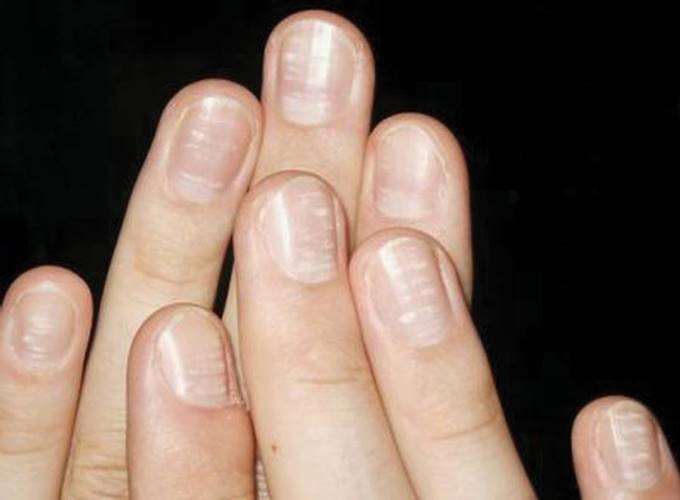 Причины неровных ногтей
