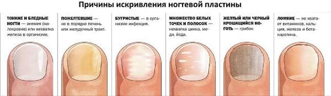 Вторичные причины искривления ногтевой пластины