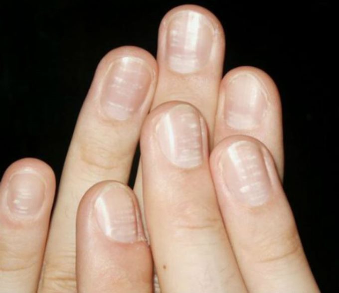 Причины белых пятен на ногтях