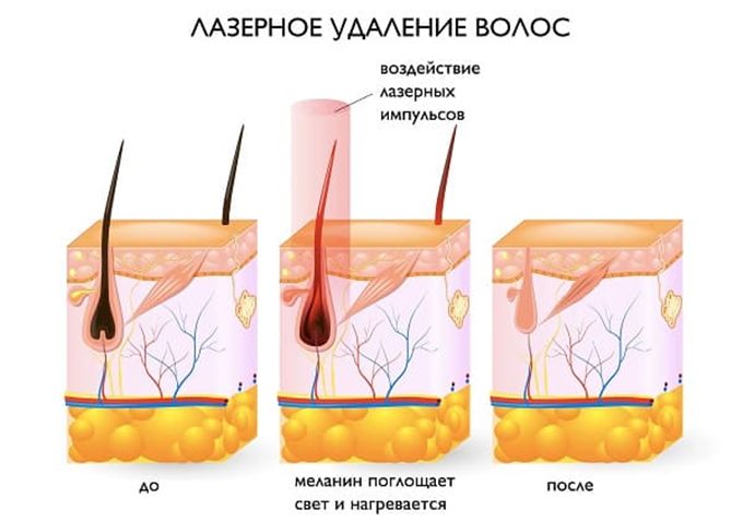 Как проходит процедура лазерной эпиляции верхней губы в салоне
