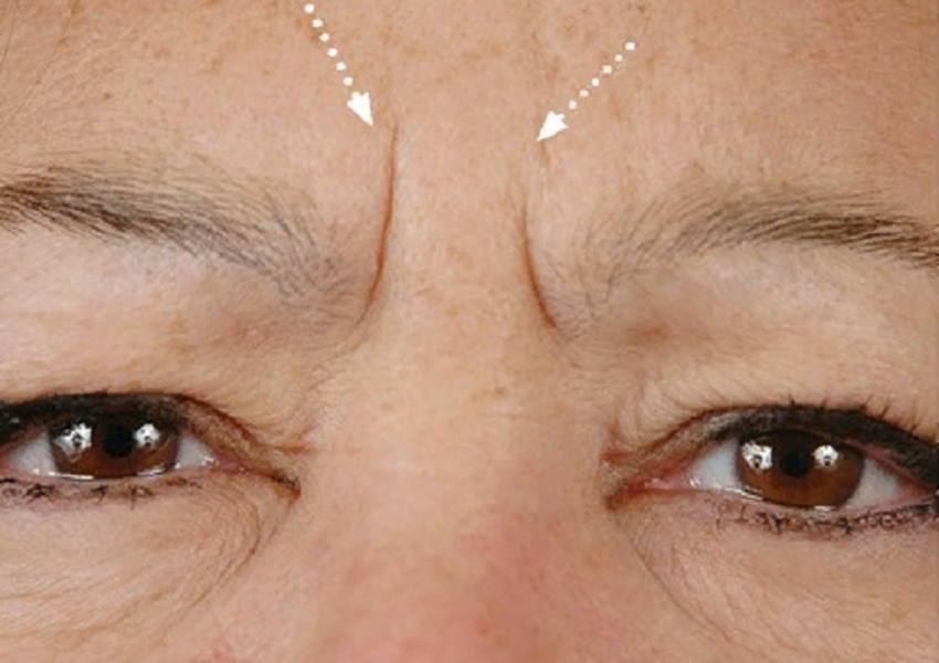Механизм формирования межбровных морщин на лице