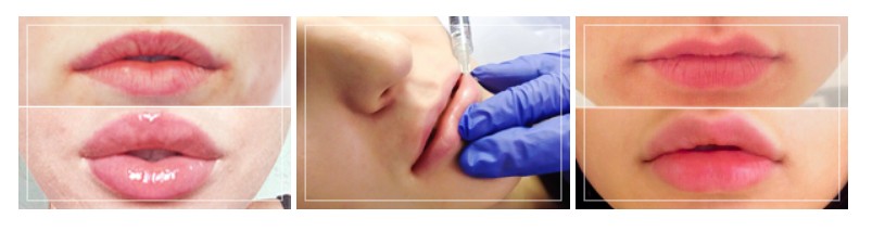 Метод коррекции формы губ