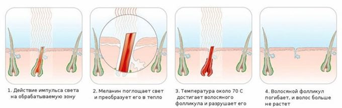 Что такое лазерная эпиляция