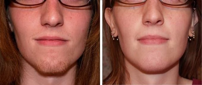 Лазерная эпиляция верхней губы: фото до и после