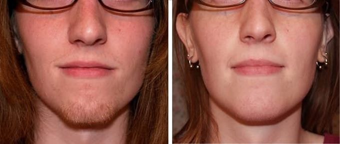 Лазерная эпиляция верхней губы: фото до и после Лазерная эпиляция верхней губы: фото до и после