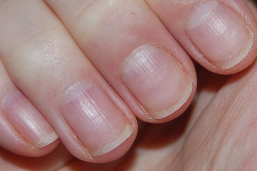 Причины появления ребристых ногтей