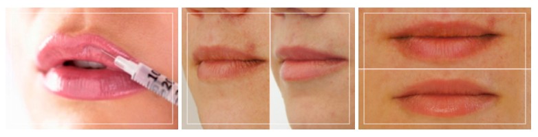 Методы устранения сухости губ