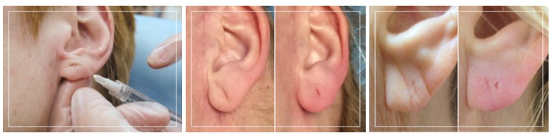 Причины провисания мочки уха