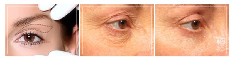 Почему кожа вокруг глаз стареет быстрее?