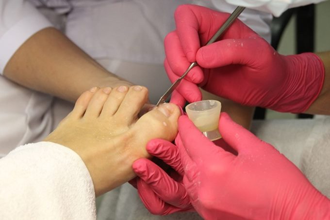 Подготовка к протезированию ногтя на ноге или руке