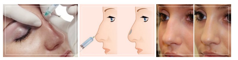 Как проводится процедура инъекционной коррекции носа