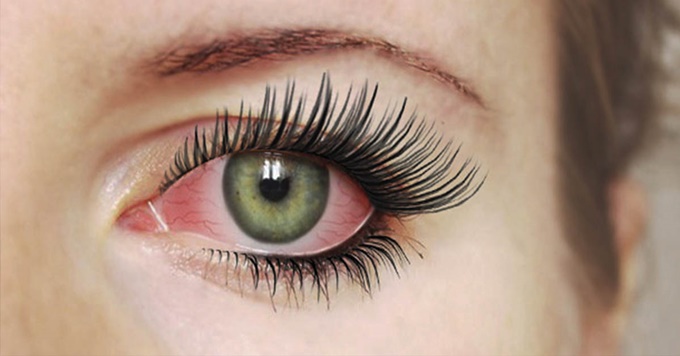 Симптомы и степени ожога слизистой глаза клеем
