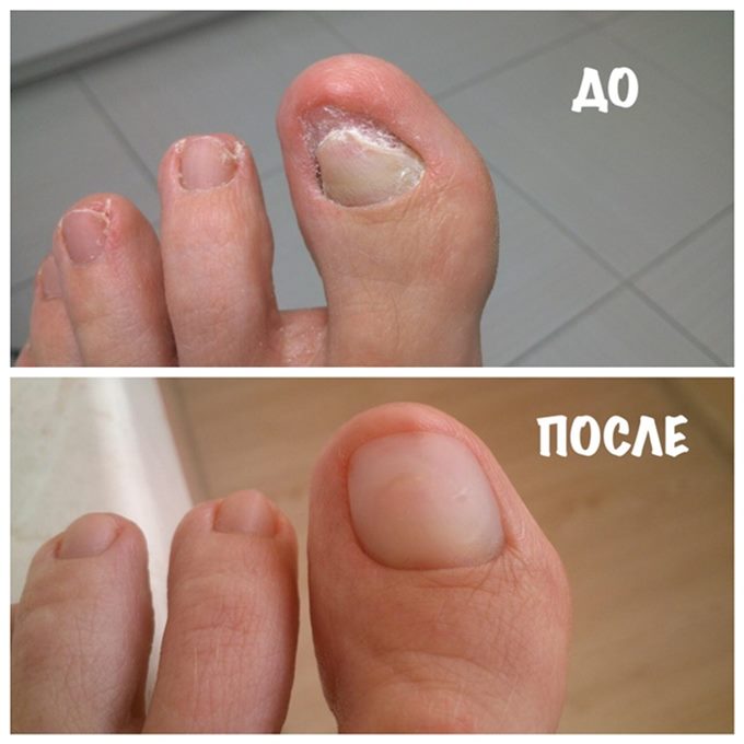 Протезирование ногтя акрилом (акрилатом).