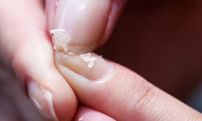 3 вида причин ломкости и расслоения ногтей