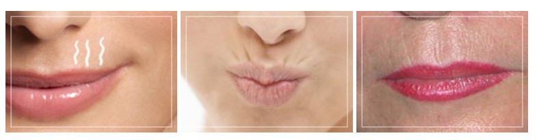 Причины появления кисетных морщин вокруг губ