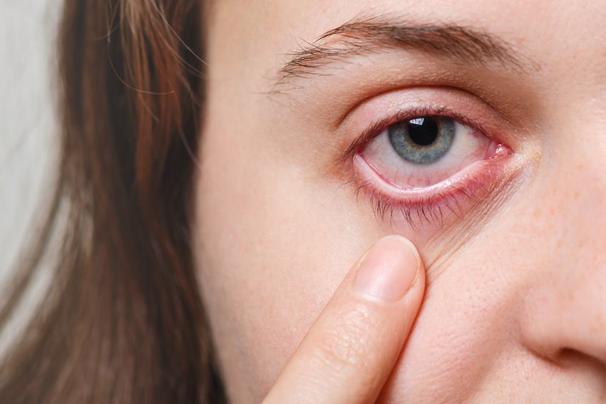 Причины покраснения глаз после наращивания