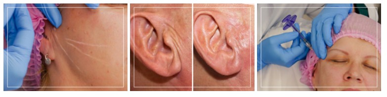 Биоревитализация уха
