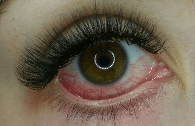 Причины ожога слизистой глаз клеем