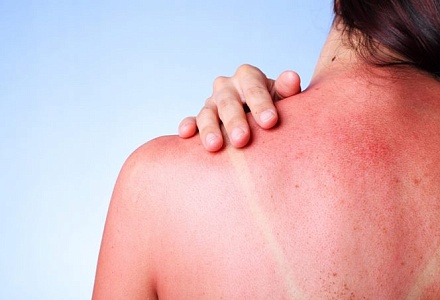 Что делать, если сгорел на солнце: советы косметологов