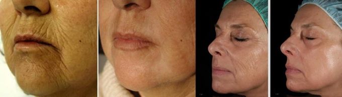Лазерное омоложение лица: фото до и после
